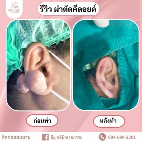 รักษาผ่าตัดคีลอยด์