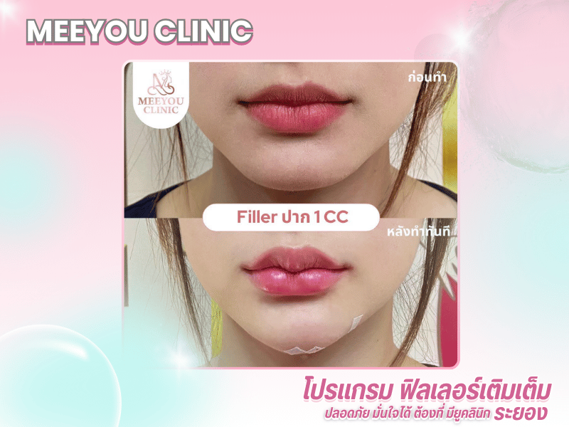 ปรับรูปหน้า ยกกระชับ เติมเต็มความอ่อนเยาว์ บริการ HIFU%2C โบท็อกซ์ และฟิลเลอร์_0